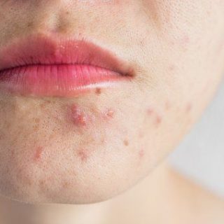 Effective hormonal acne remedies 14 3 ways a pediatric chiropractor can help your newborn