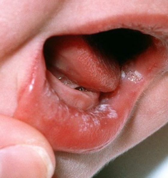 Everything you need to know about thrush 6 Everything you need to know about thrush