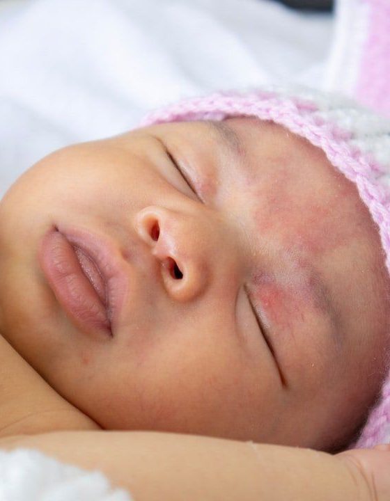 3 things to know about newborn acne 3 3 things to know about newborn acne