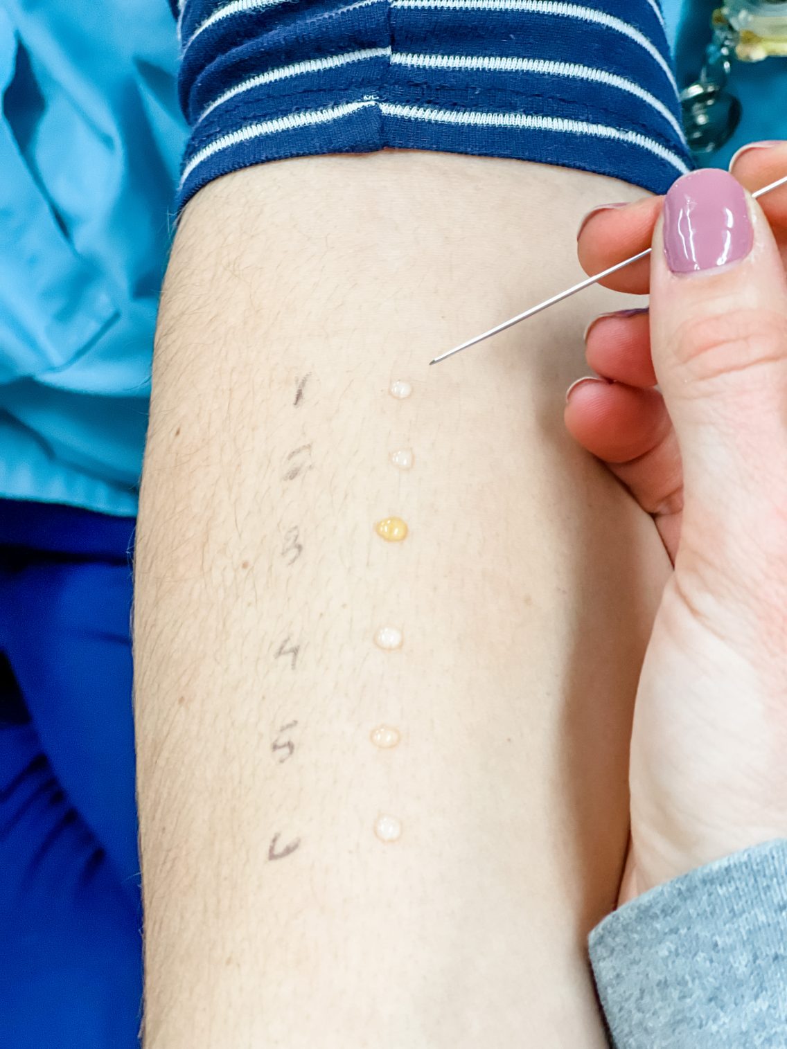 Food allergy basics – everything parents need to know
